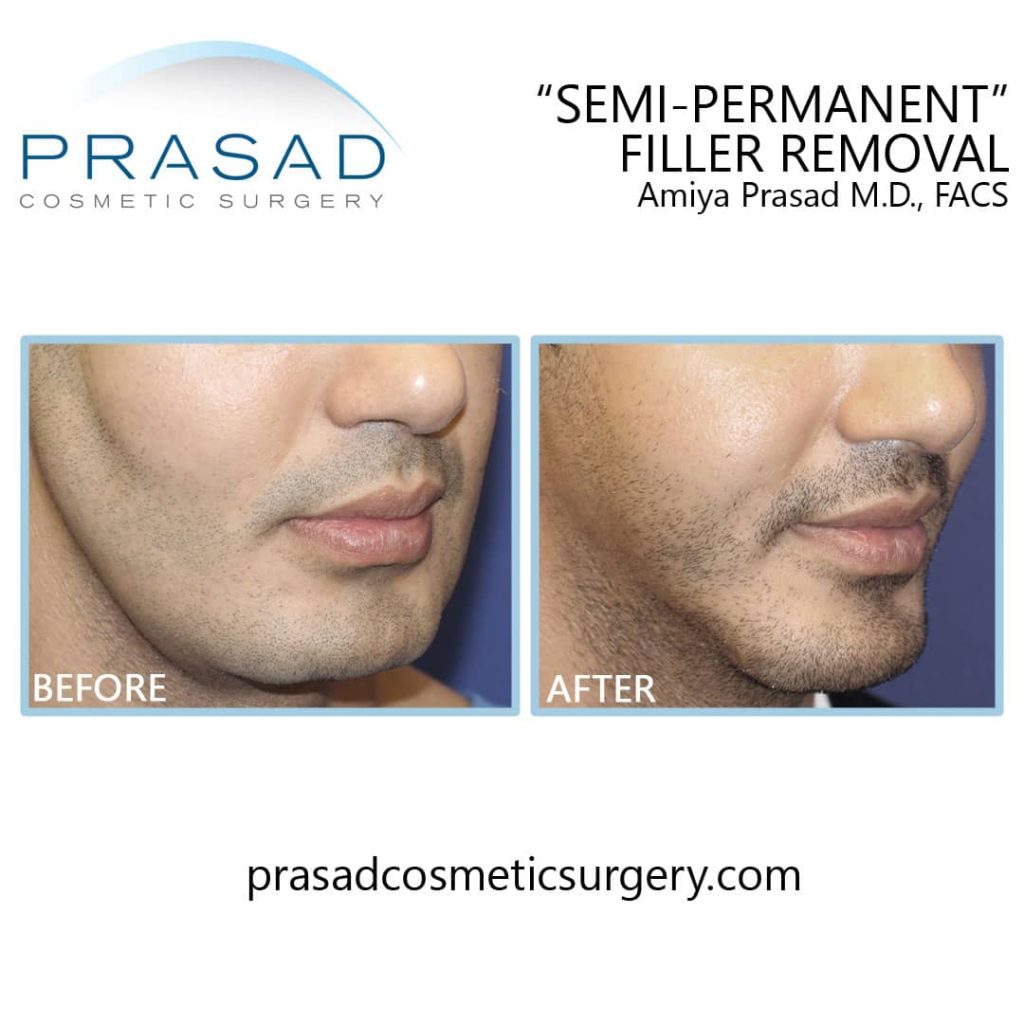 Dermal Filler Removal