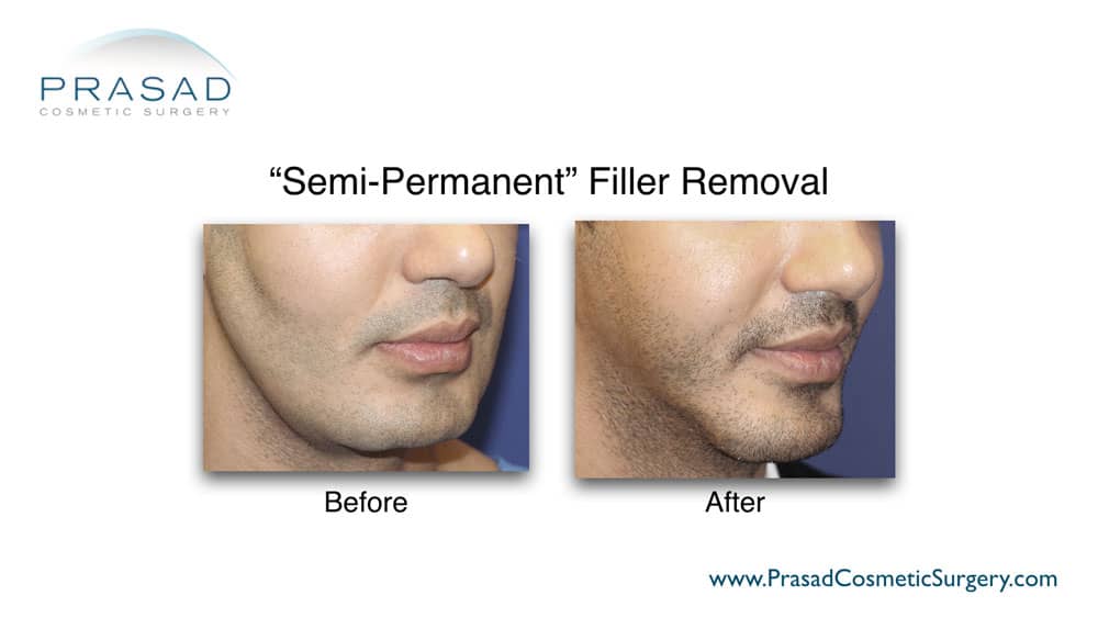 semi-permanent cheek and jaw filler removal before and after