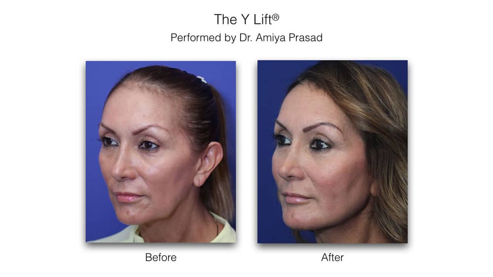 y-lift cheek filler before and after