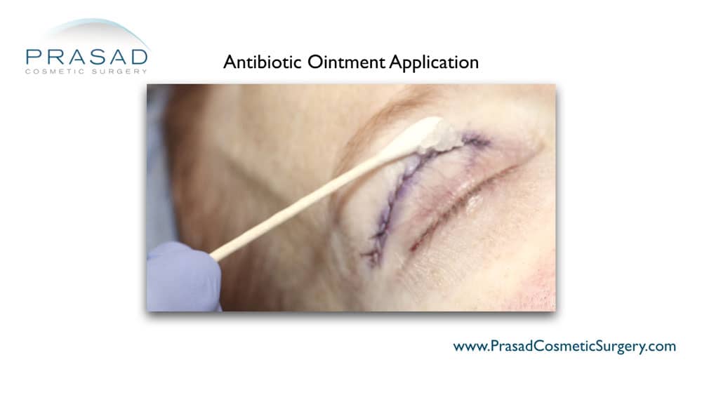 antibiotic ointment application to upper eyelid sutures Amiya Prasad MD