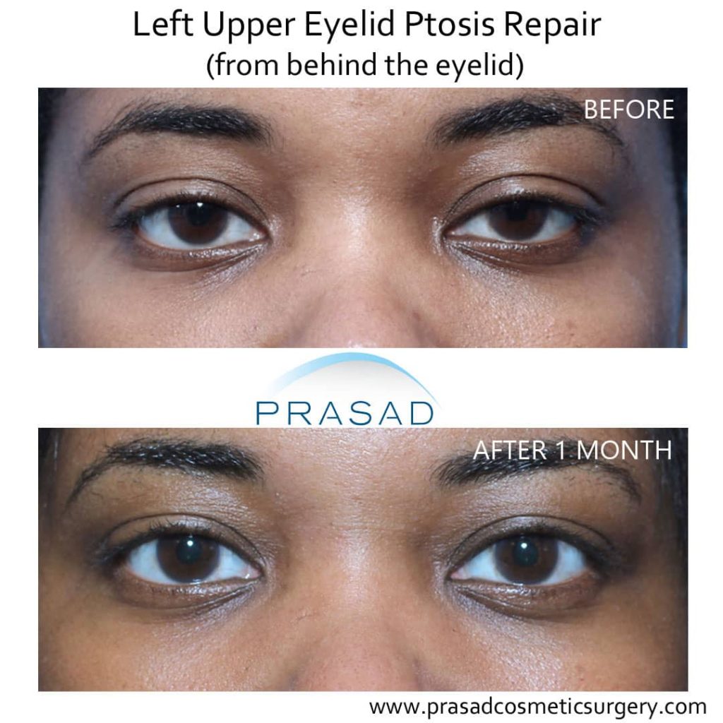 droopy eyelid surgery before and after 1 month recovery time