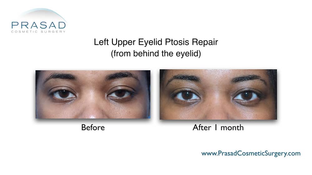 droopy eyelid surgery procedure done at Prasad Cosmetic Surgery New York