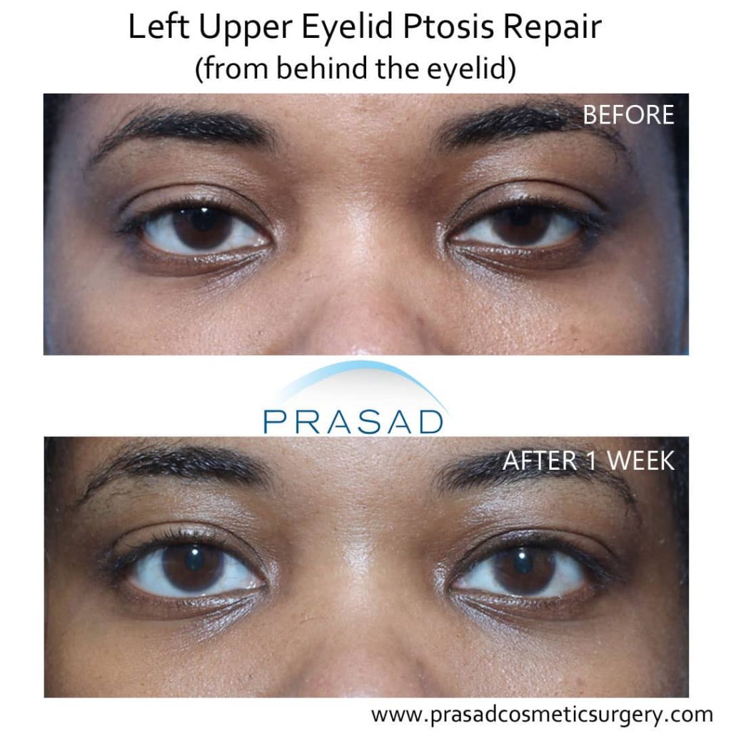 droopy eyelid surgery before and after 1 week recovery