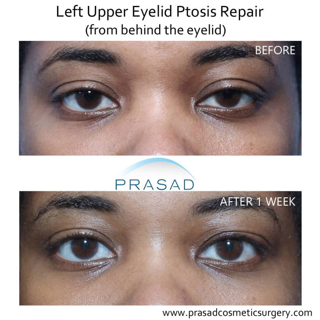 Is Ptosis Surgery Covered By Insurance - Cmea