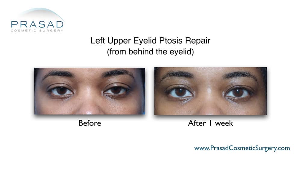 droopy eyelid surgery on the left eye before and after 1 week recovery time