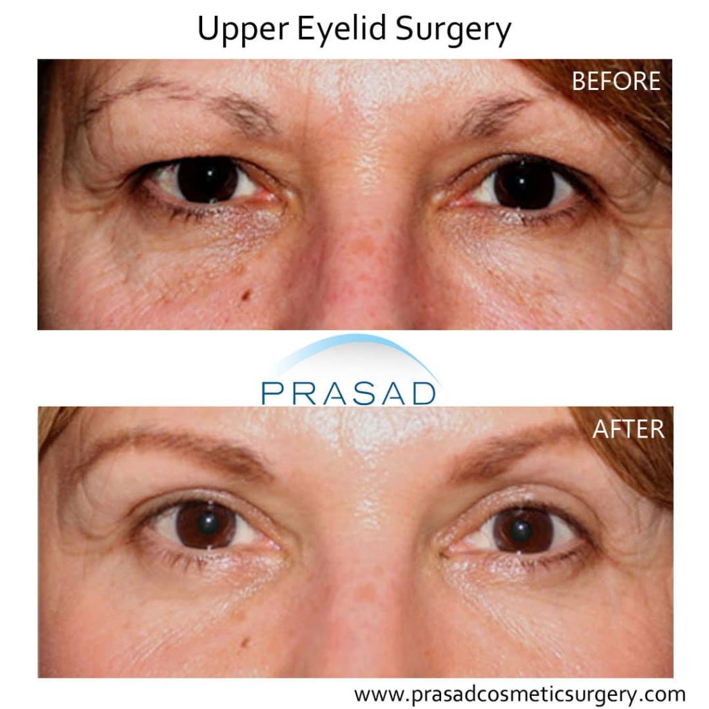 Hooded Eye Surgery Before and After