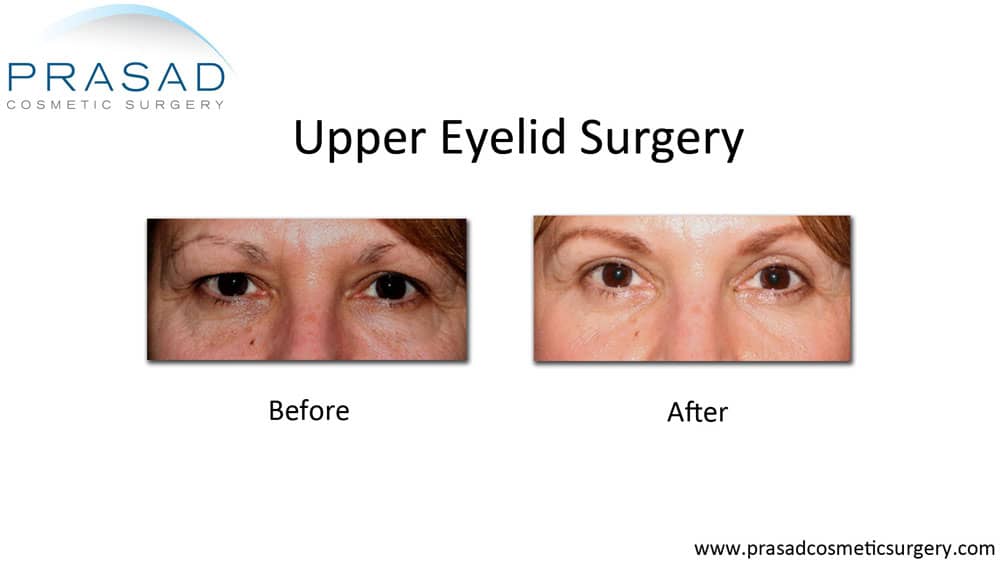 Hooded Eye Surgery Before and After procedure by Dr. Amiya Prasad