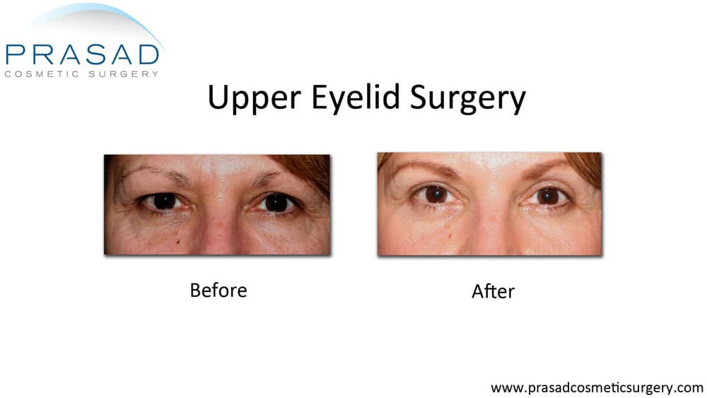 How Hooded Eye Surgery Scars are Minimized | Dr. Prasad Blog