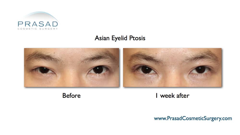 asian eyelid ptosis surgery before and after 1 week recovery (asymmetrical eyes surgery)