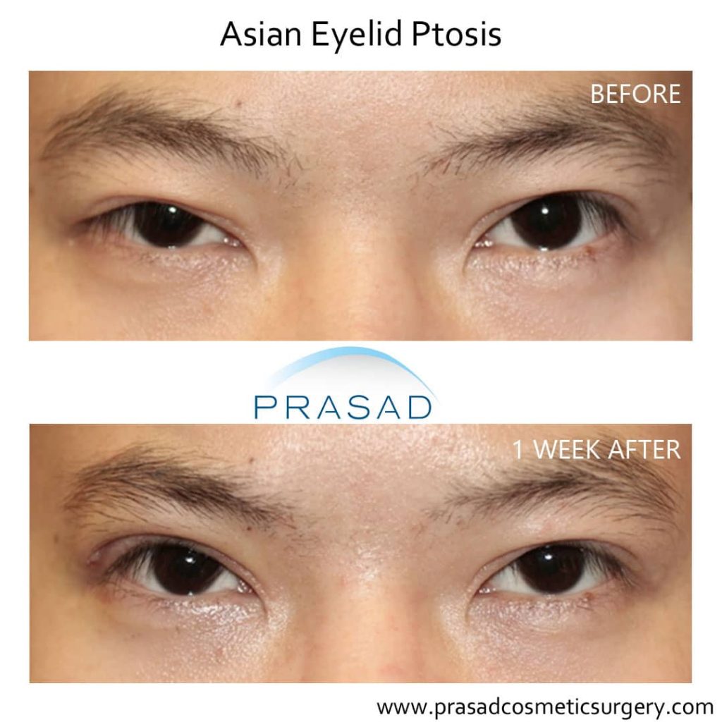 1 week recovery after ptosis surgery (asymmetrical eyes surgery)