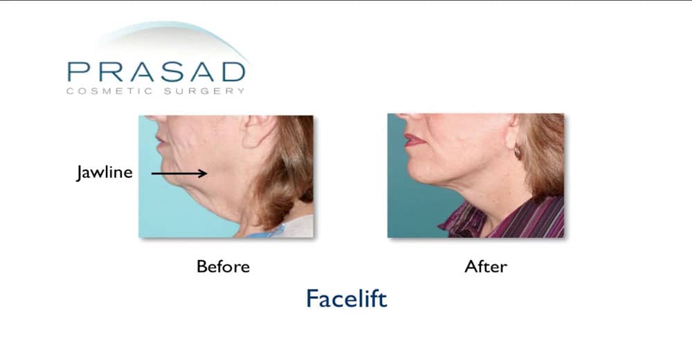 neck skin tightening before and after