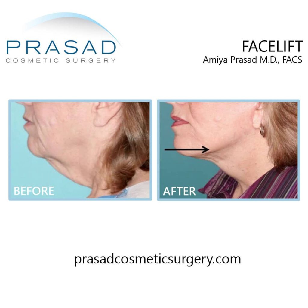 lower face and neck tightening before and after