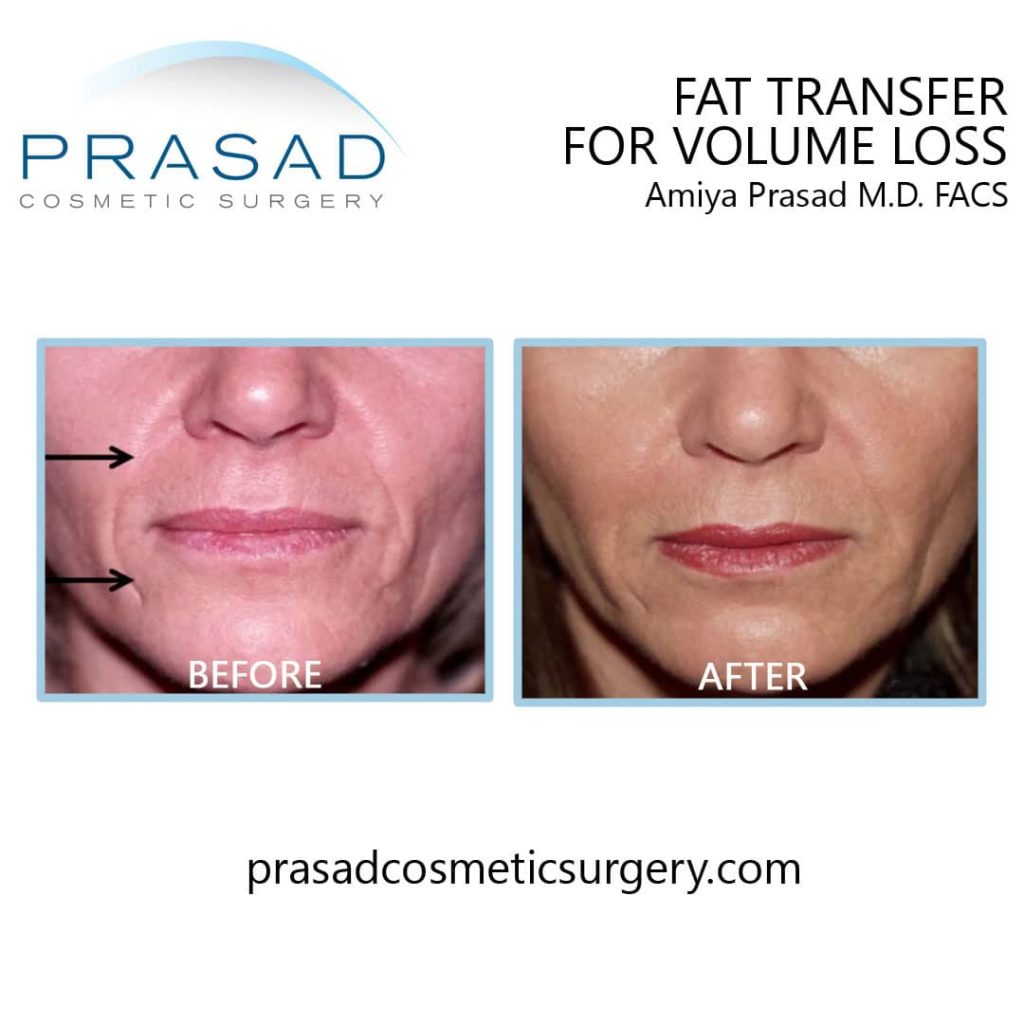 fat grafting face for before and after