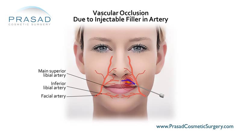 Vascular Occlusion Due to Injectable Filler in Artery illustration