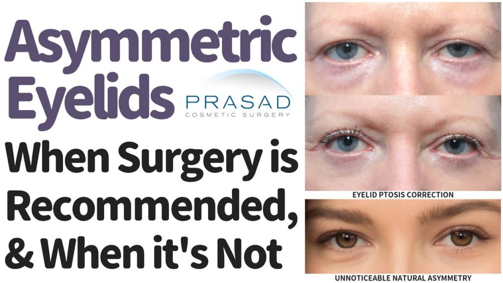 Asymmetrical eyes - when surgery is recommended when its not
