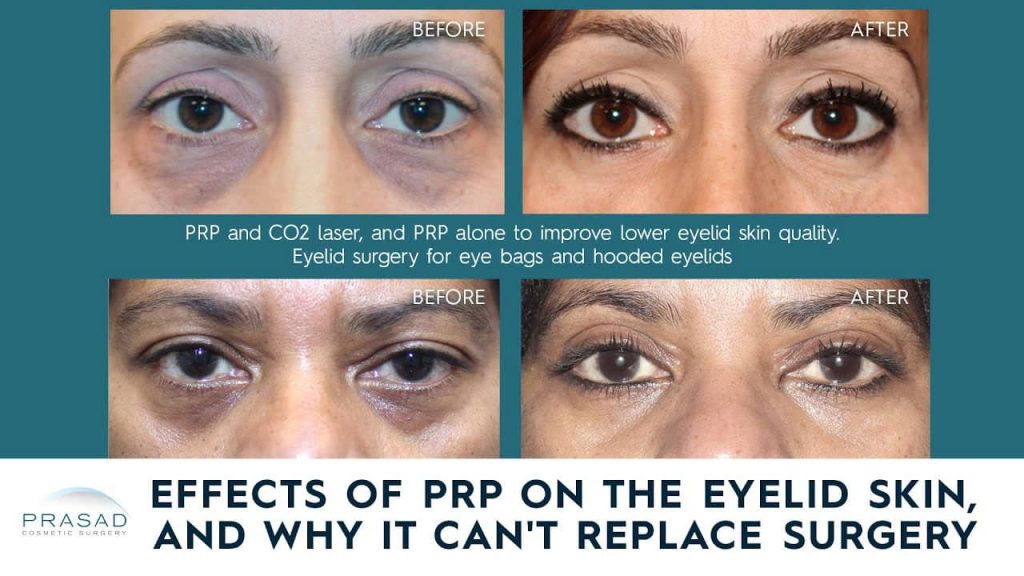 effects of PRP injection under eyes