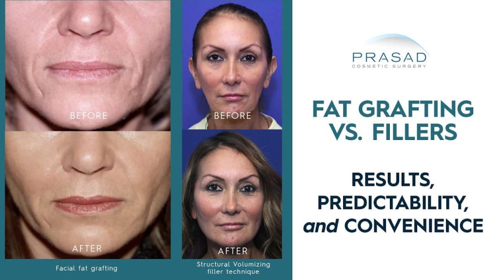 fat grafting face vs fillers