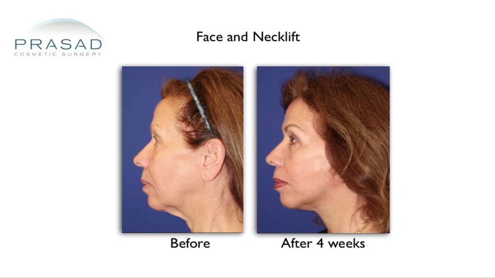 Neck skin tightening with surgery