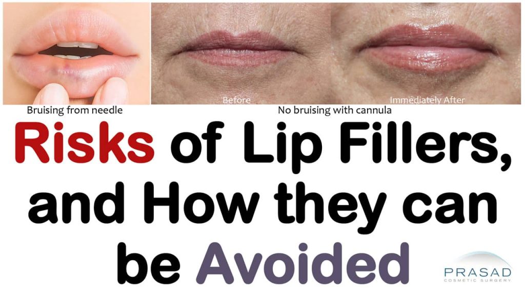 risks of lip fillers and how they can be avoided