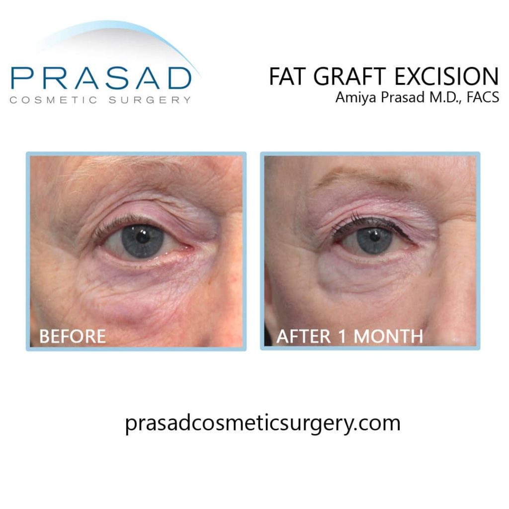 Fat graft excision before and after