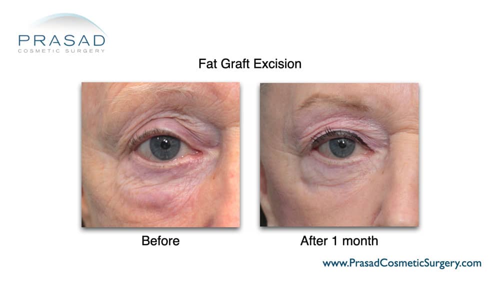 Fat graft excision performed by Dr. Amiya Prasad before and after