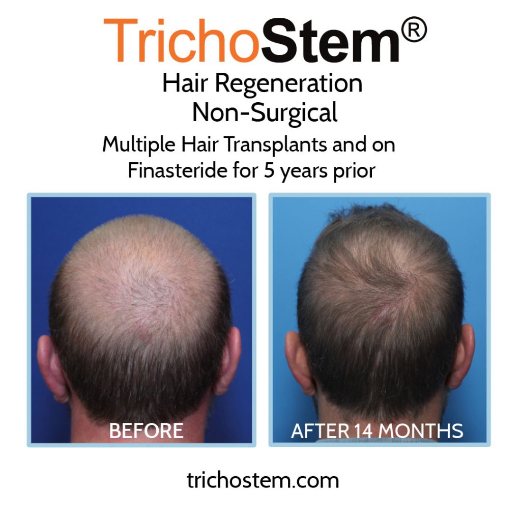 hair transplant alternative results before and after 14 months