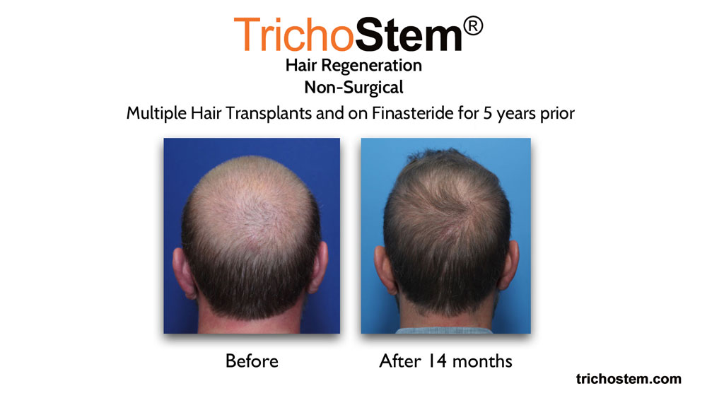 hair regeneration results before and after 14 months