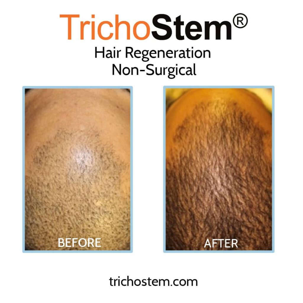 Hair regeneration results before and after