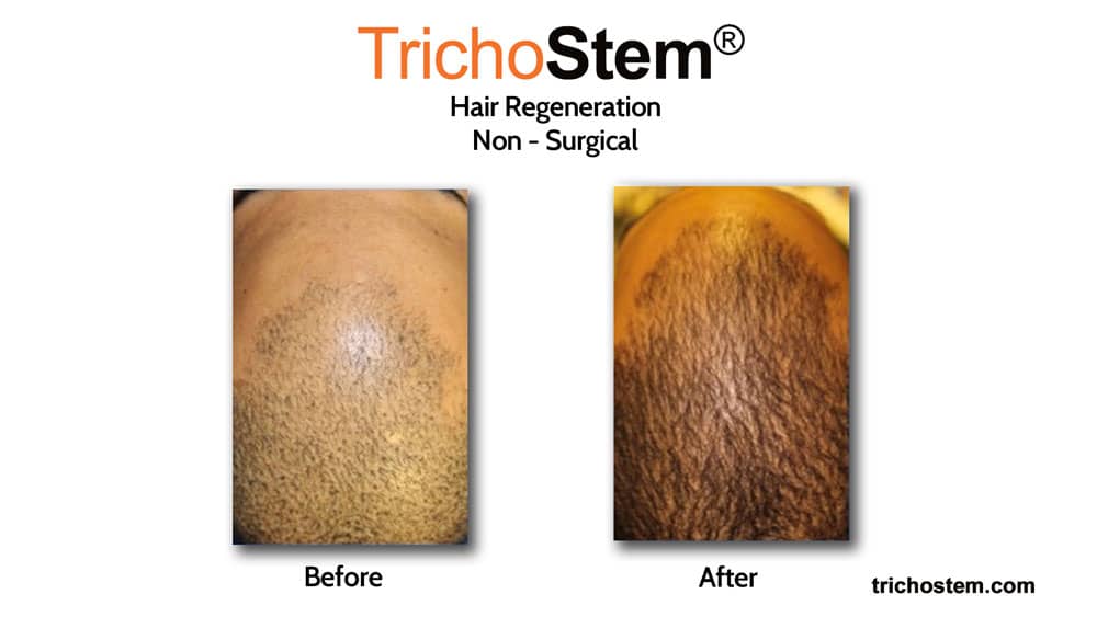 Hair transplant alternative results before and after