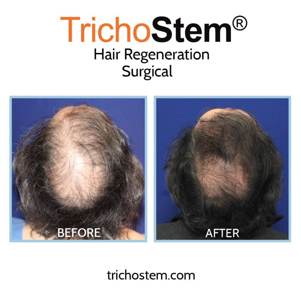 Hair regeneration and Hair transplant before and after