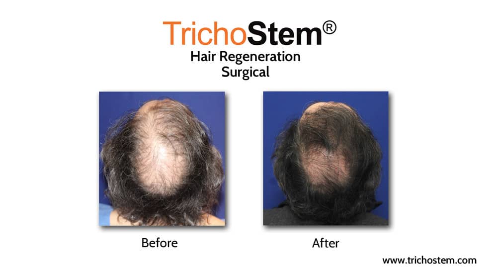 Hair regeneration and Hair transplant results