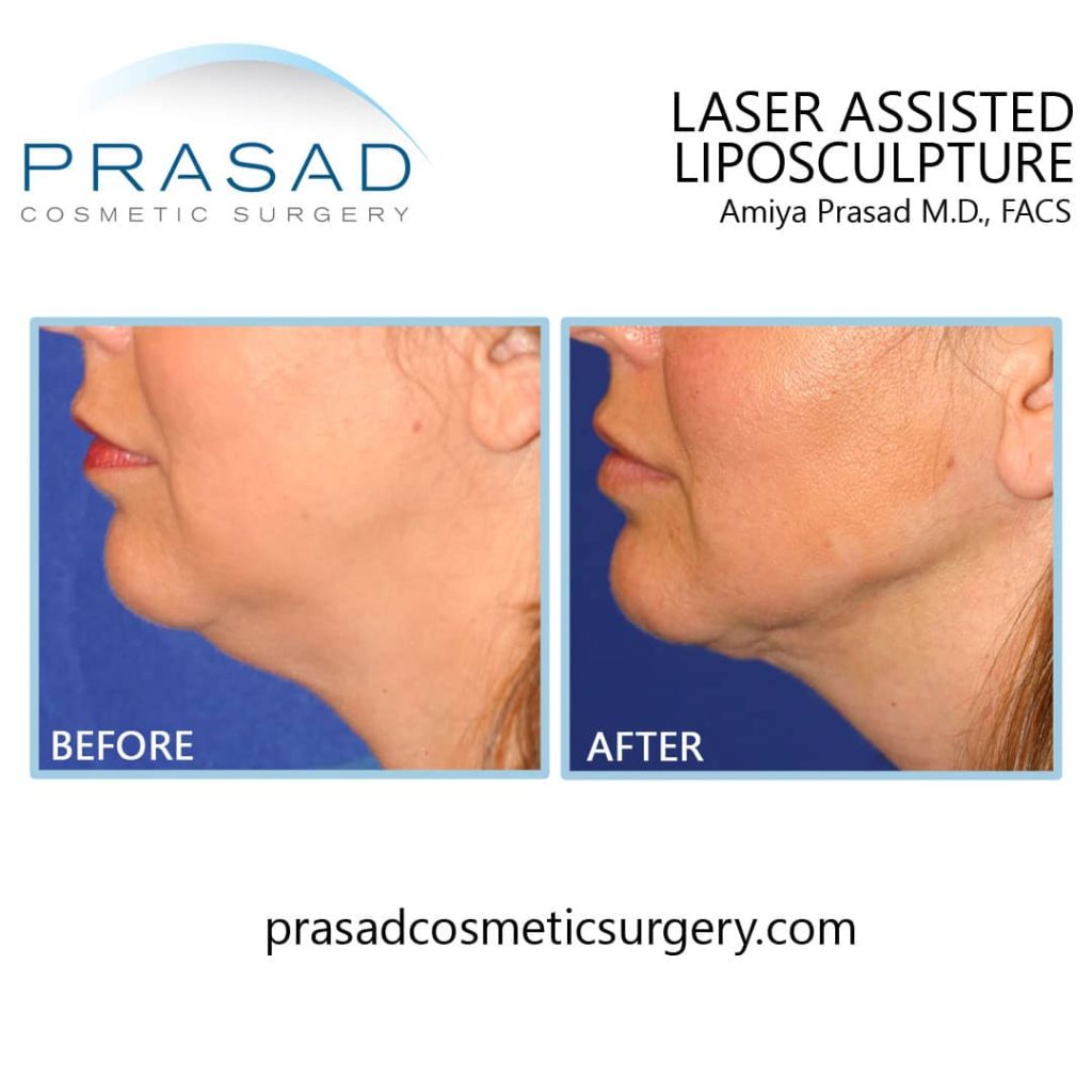 Under chin fat removal before and after