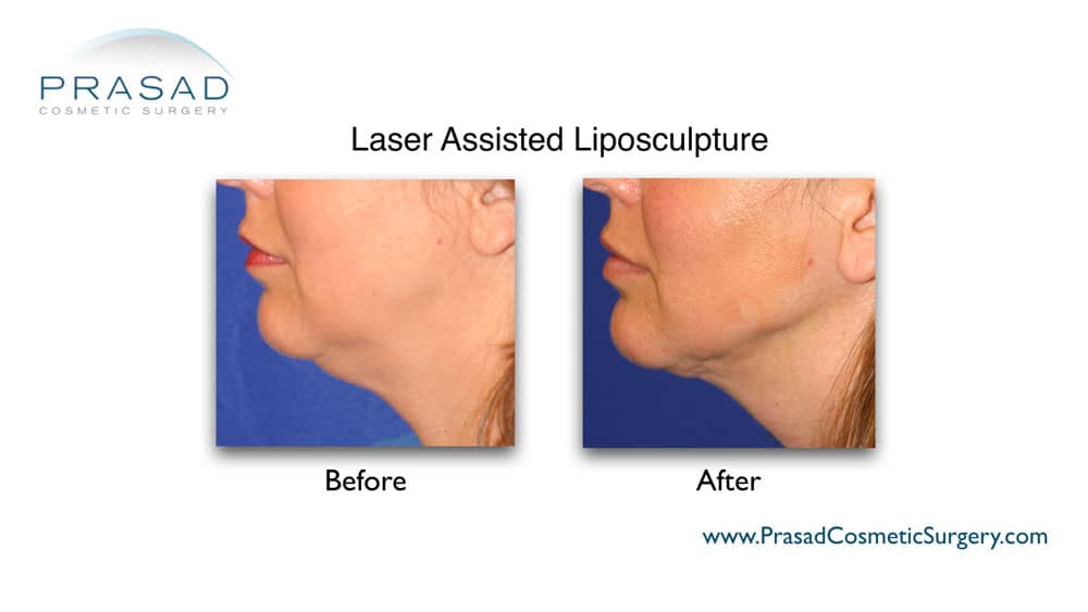 laser assisted Chin liposuction before and after