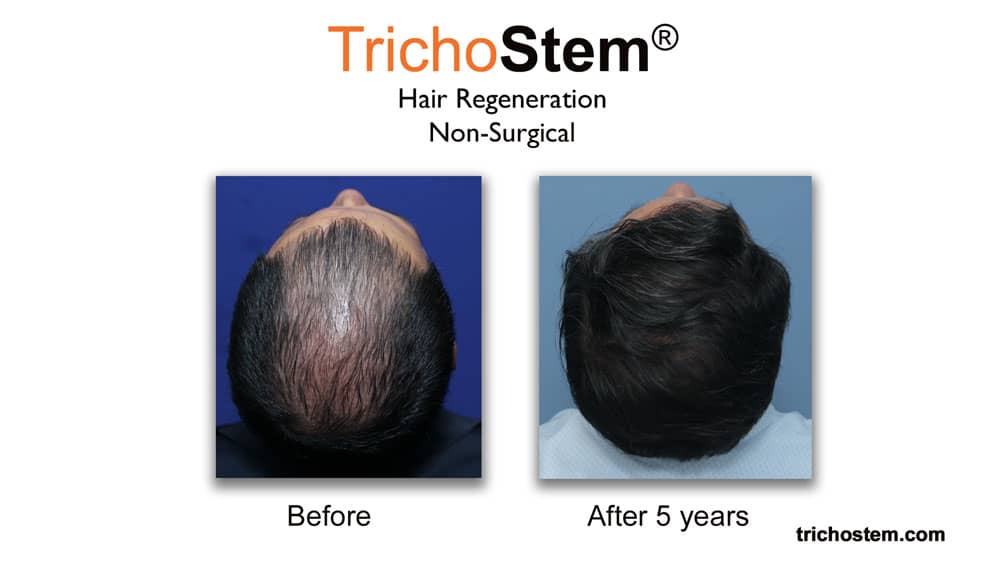 TrichoStem Hair Regeneration before and after 5 years results
