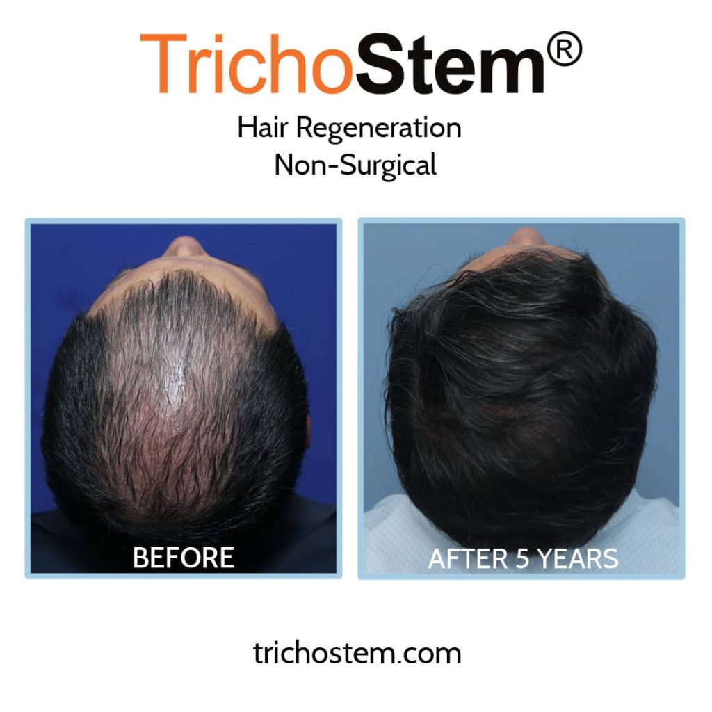 Hair transplant alternative before and after 5 years results