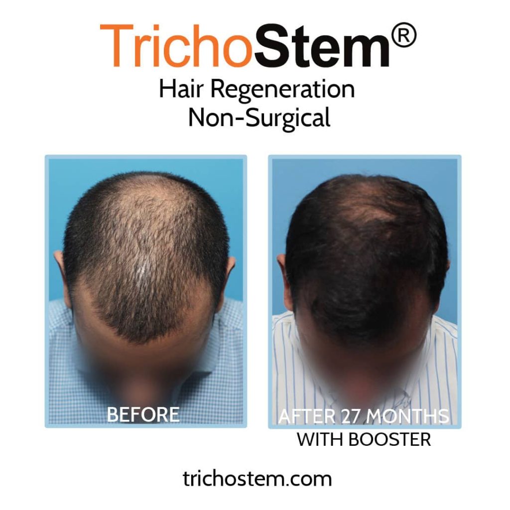 Hair transplant alternative before and after 27 months