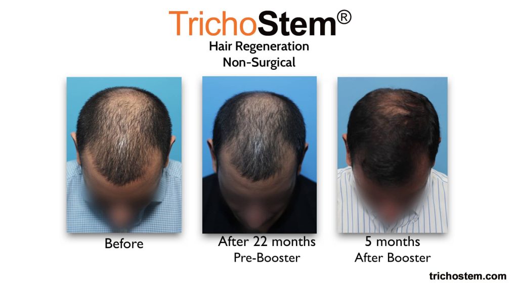 TrichoStem Hair Regeneration before and after 27 months with booster treatment