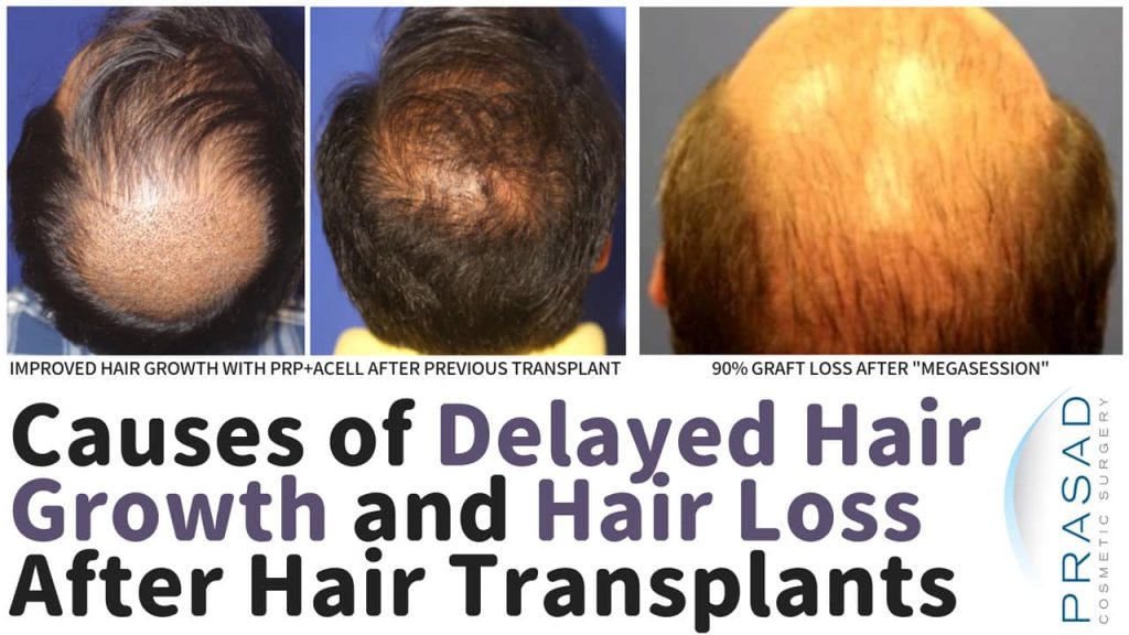 causes of delayed hair growth and hair loss after hair transplants