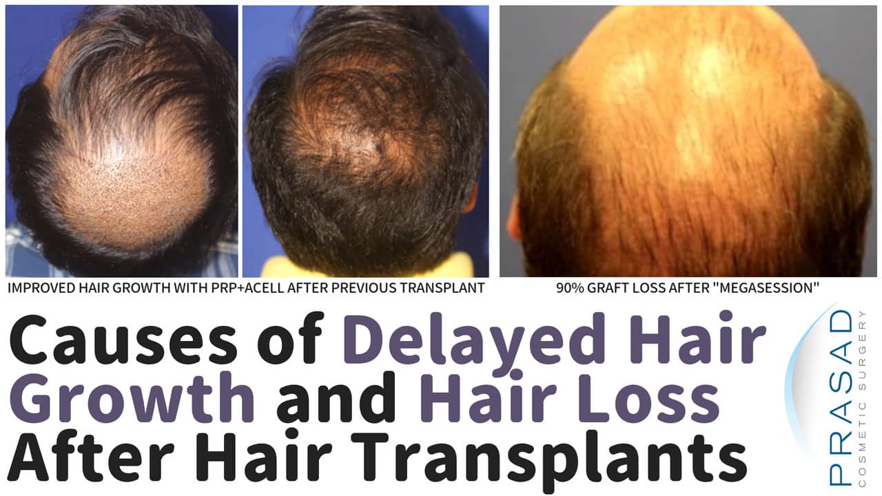 Delayed Hair Growth and Hair Loss After Hair Transplant