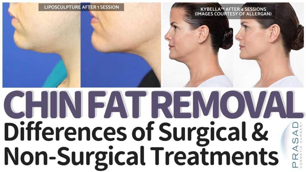 double chin removal or chin fat removal
