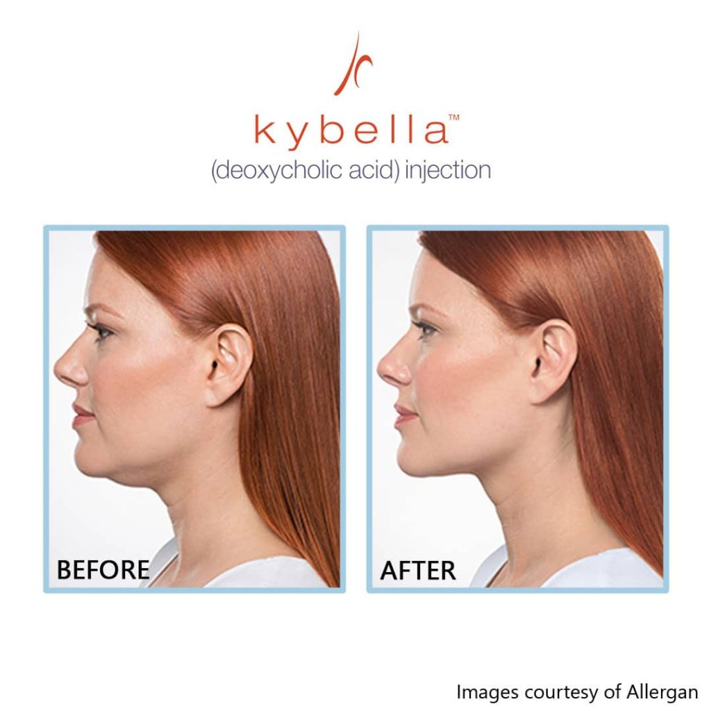 double chin removal non-surgical with kybella before and after