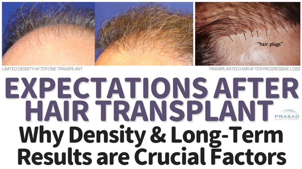 hair transplant results what to expect