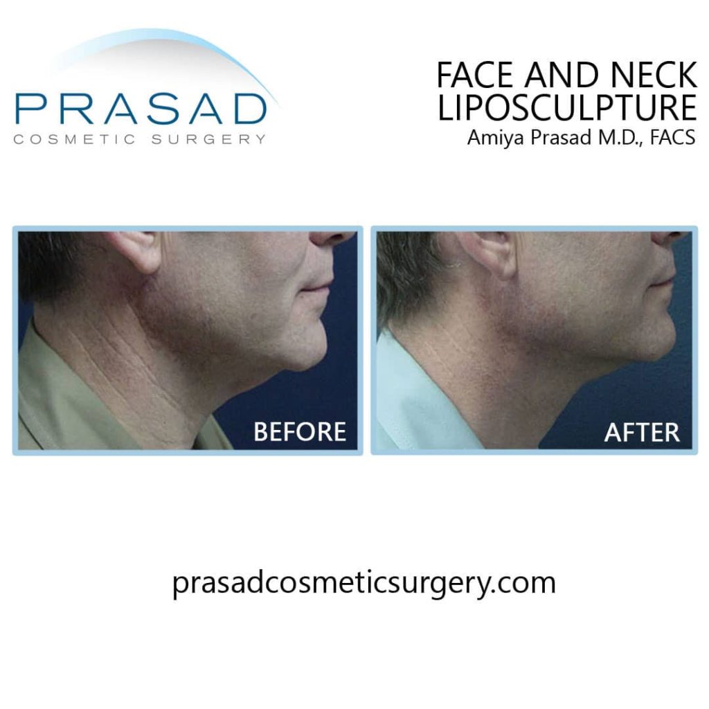 surgical chin fat removal before and after