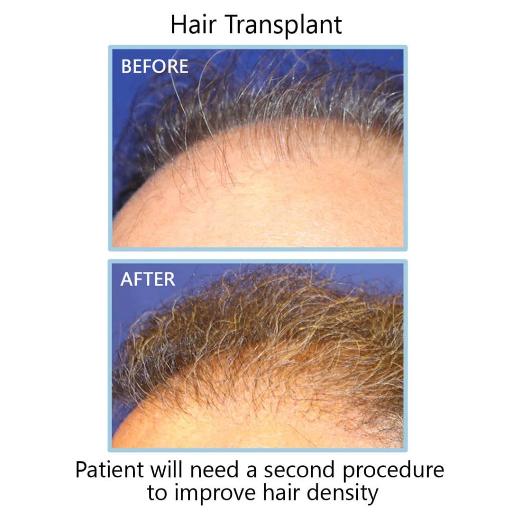 hair density results after 1 hair transplant