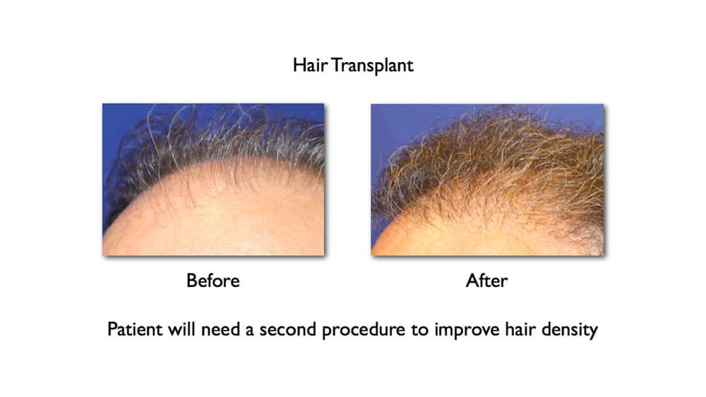 1 session of Hair transplant before and after