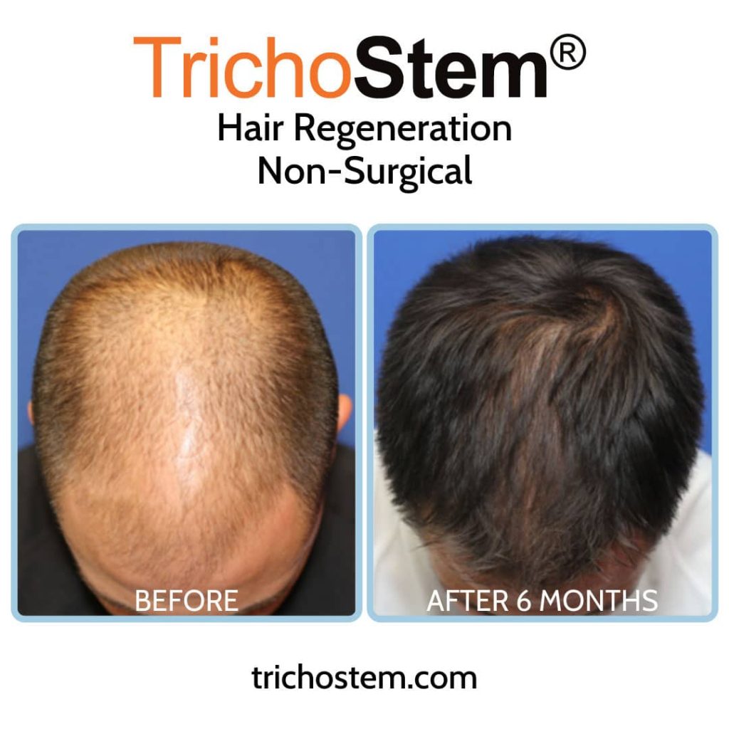 hair transplant alternative before and after hair regeneration