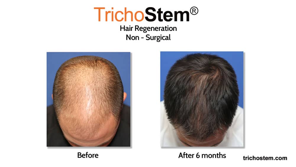 before and after hair transplant alternative