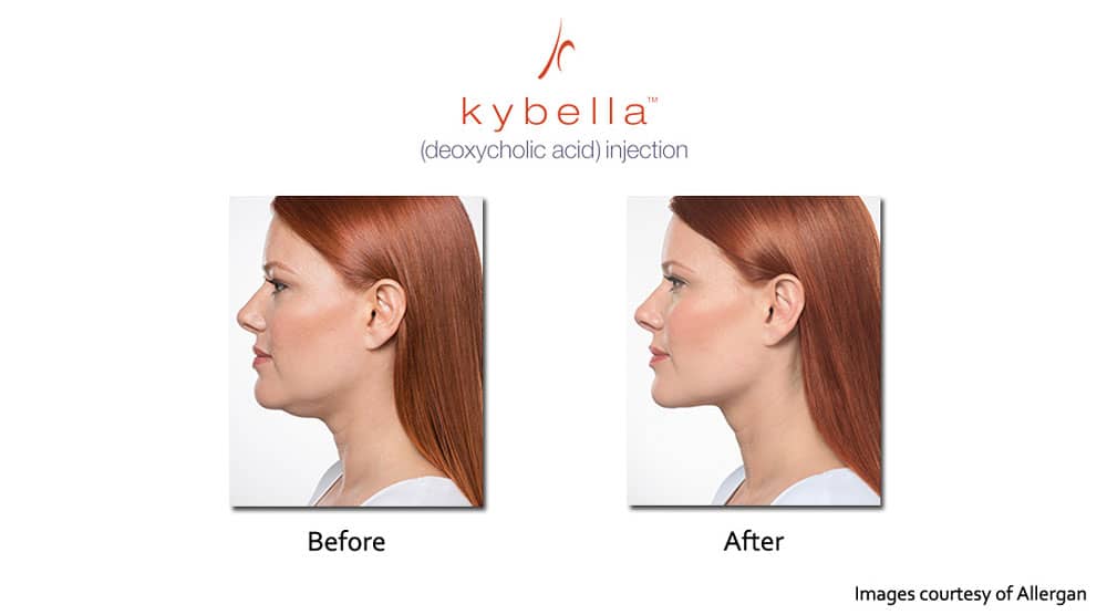 Kybella double chin removal before and after