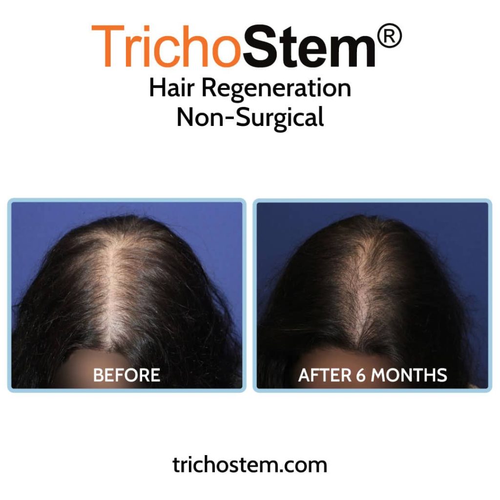 TrichoStem Hair Regeneration female pattern hair loss before and after 6 months face down