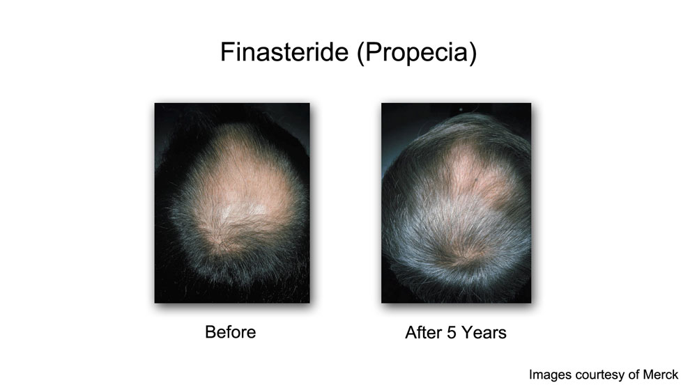 Finasteride propecia before and after hair loss treatment for men